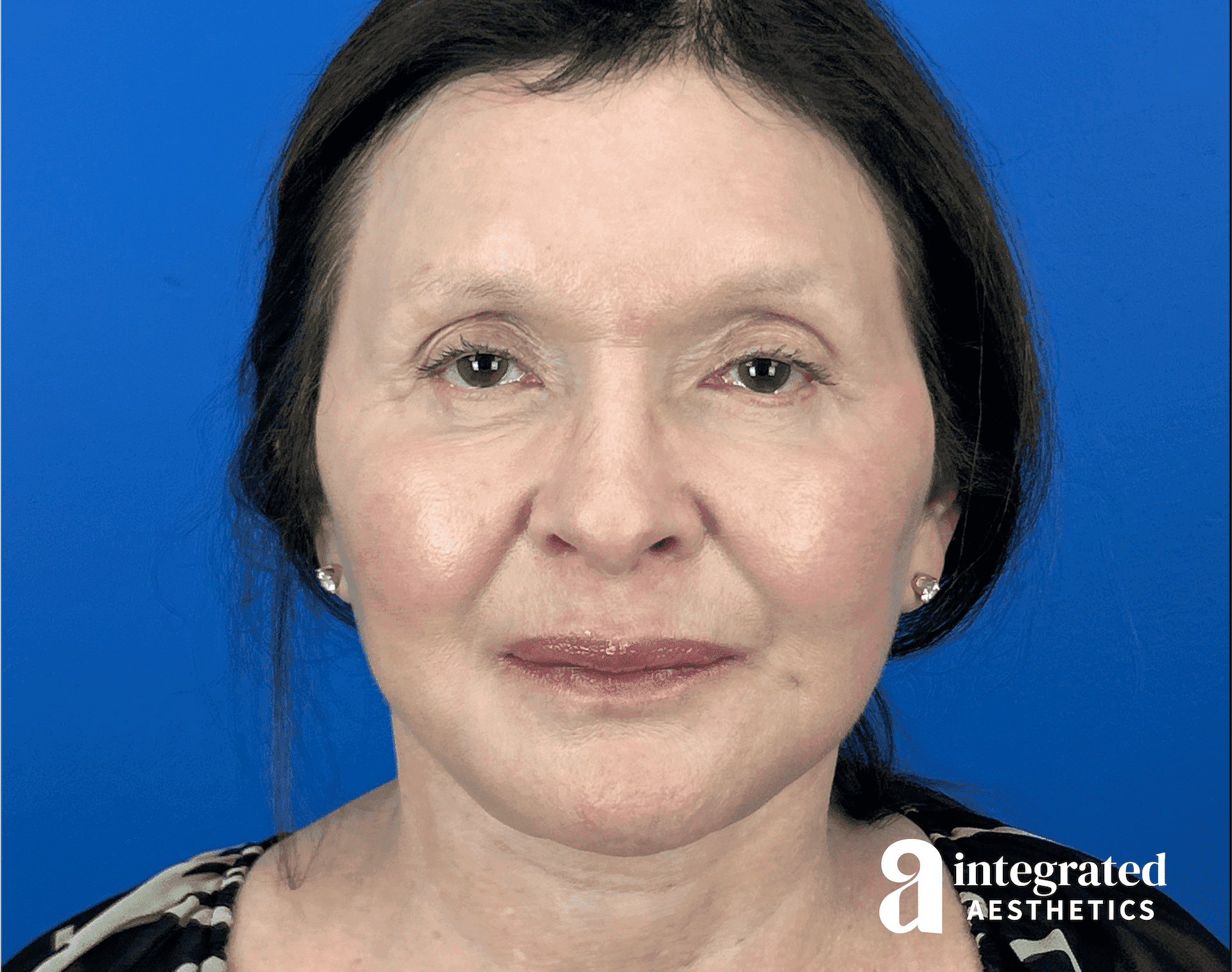 Facelift & Neck Lift