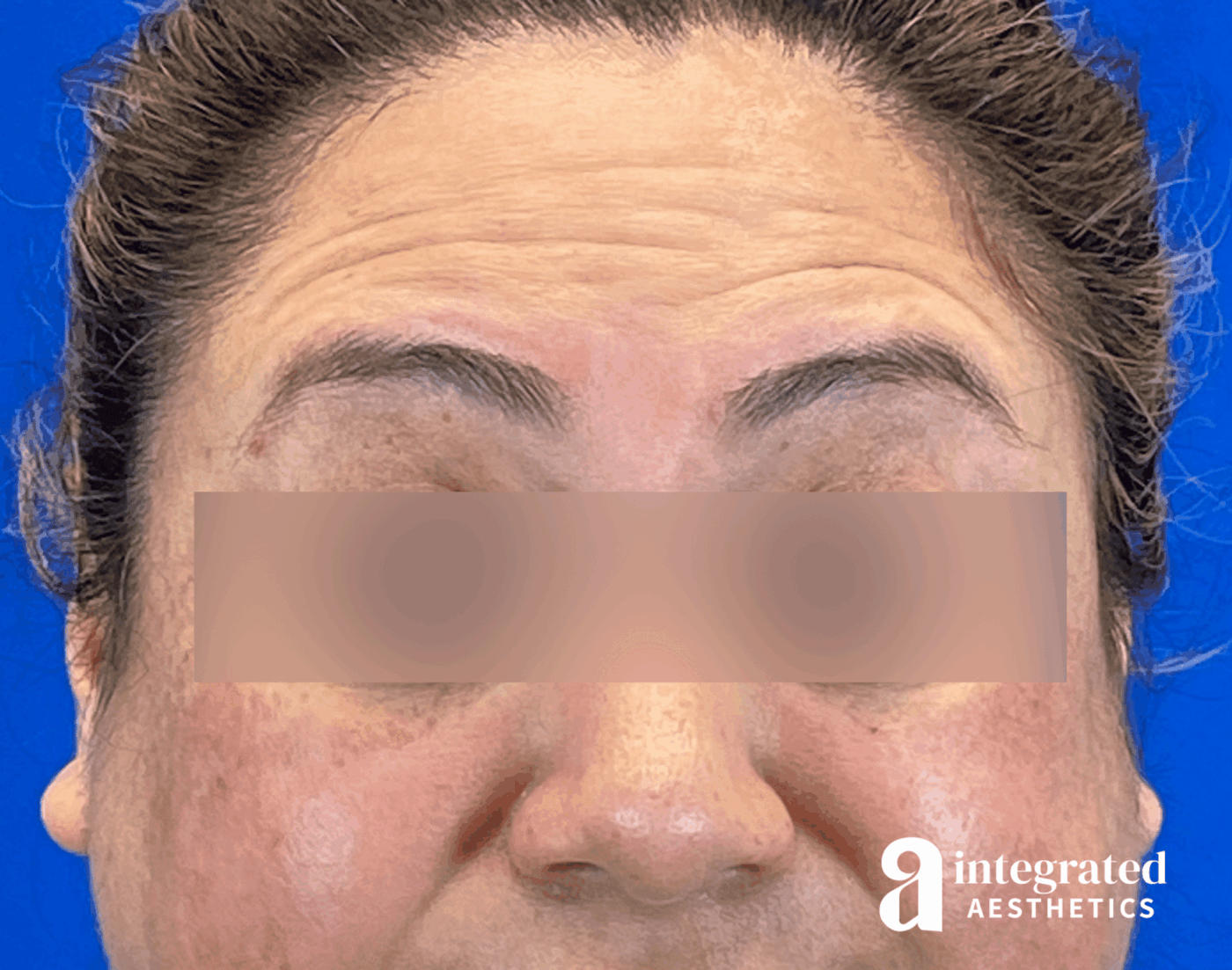 Wrinkle Relaxers Before & After Gallery - Patient 930885 - Image 1