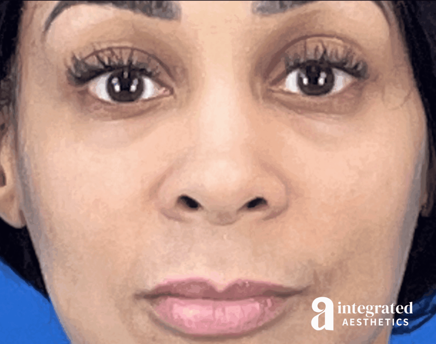 Resolved Aesthetic Complications