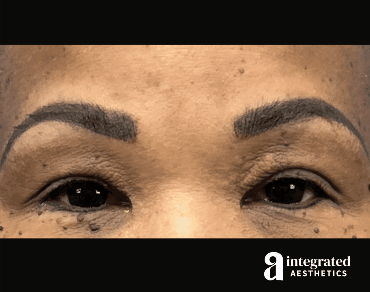 Blepharoplasty