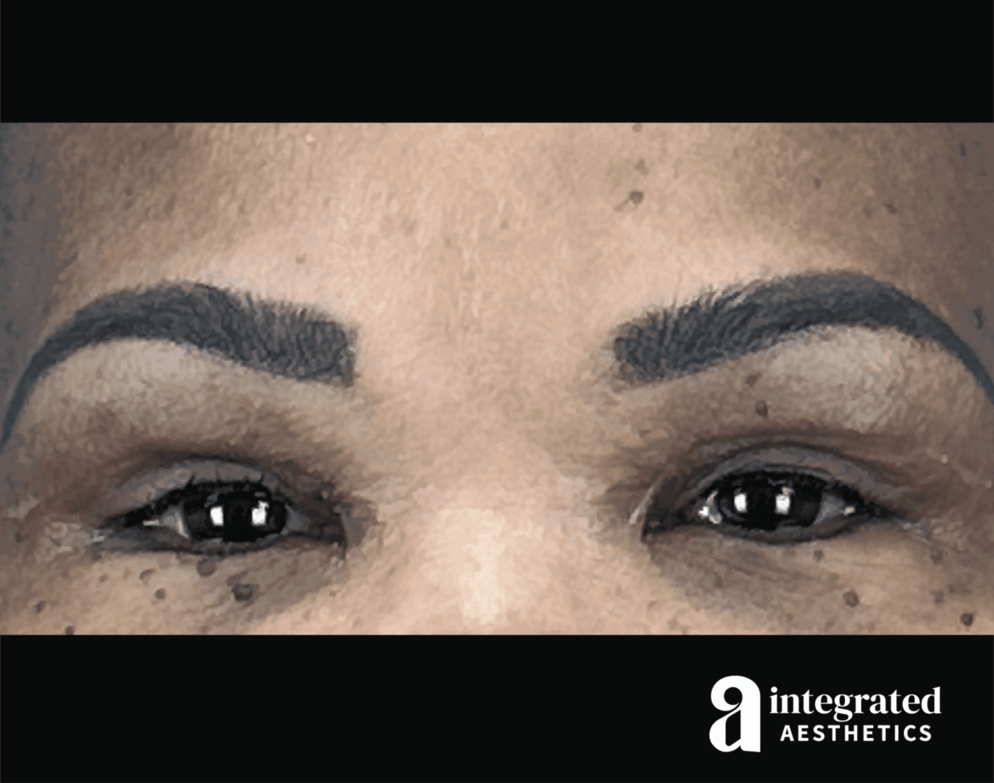 Blepharoplasty