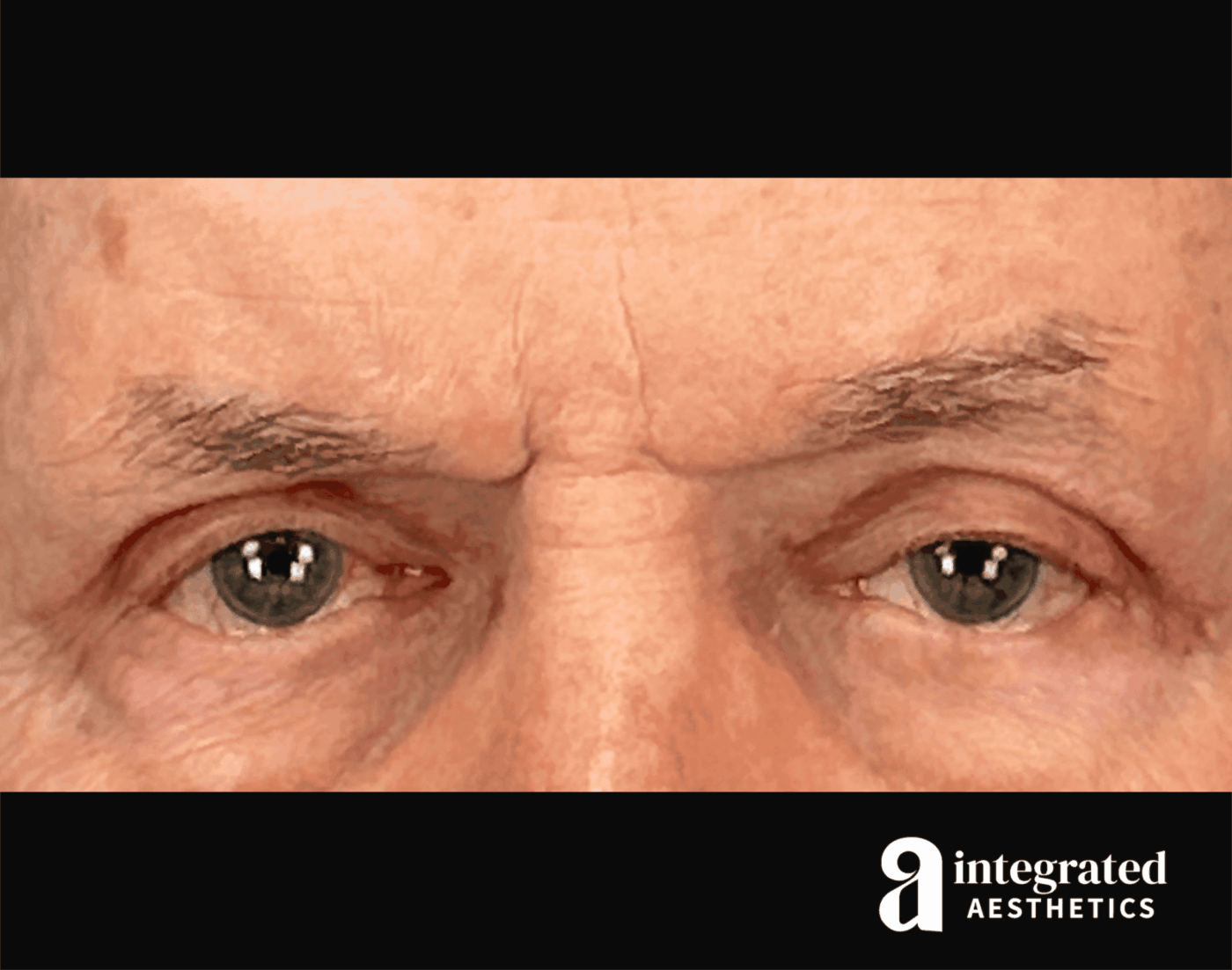 Blepharoplasty