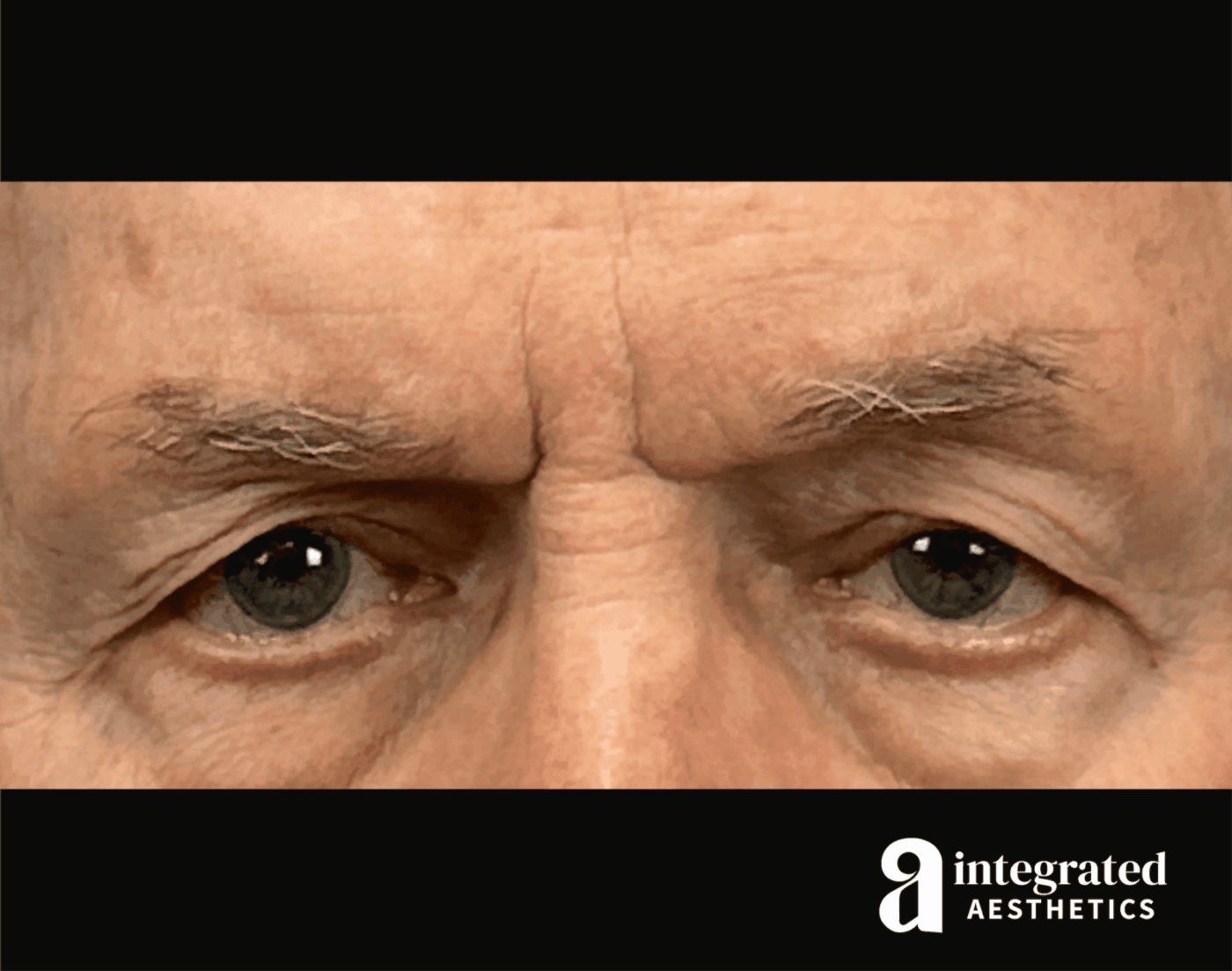 Blepharoplasty