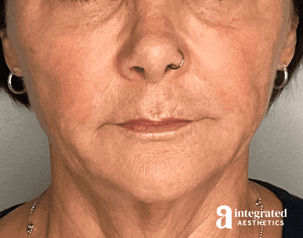 Lip Filler