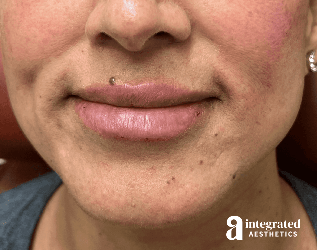 Dermal Fillers