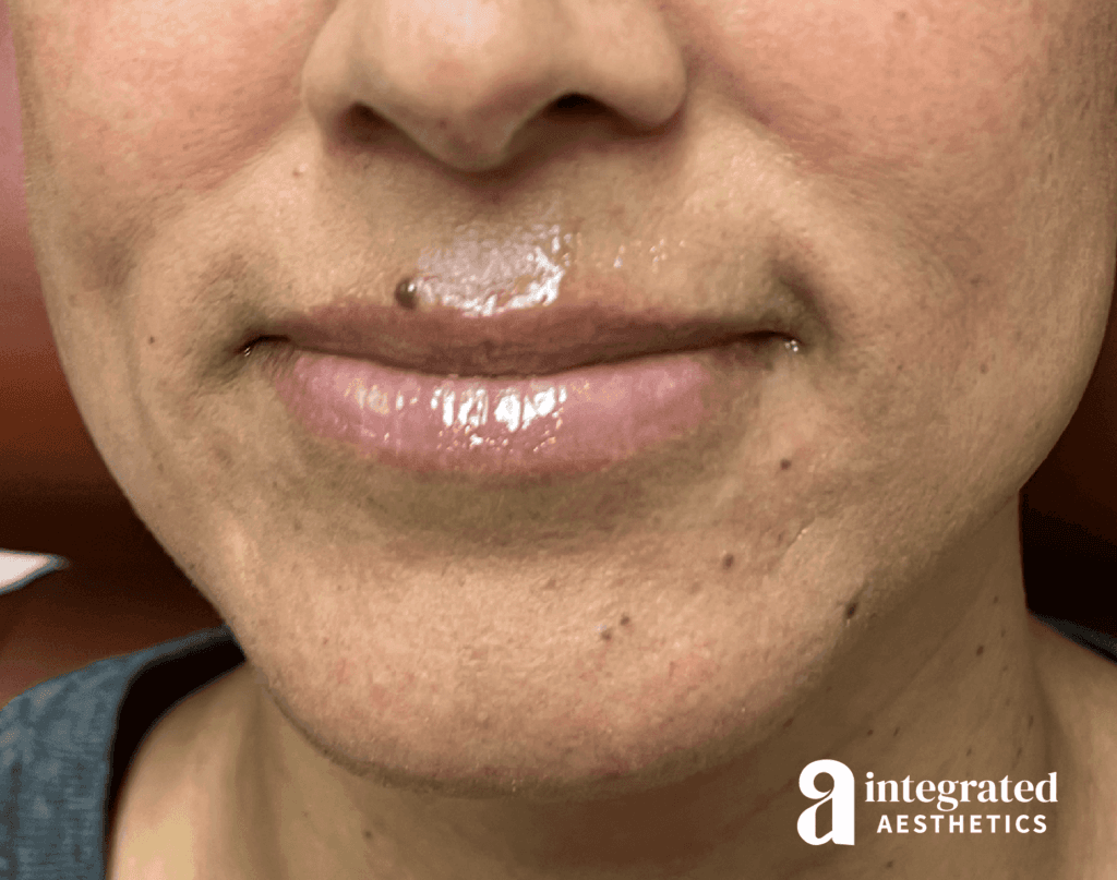 Dermal Fillers