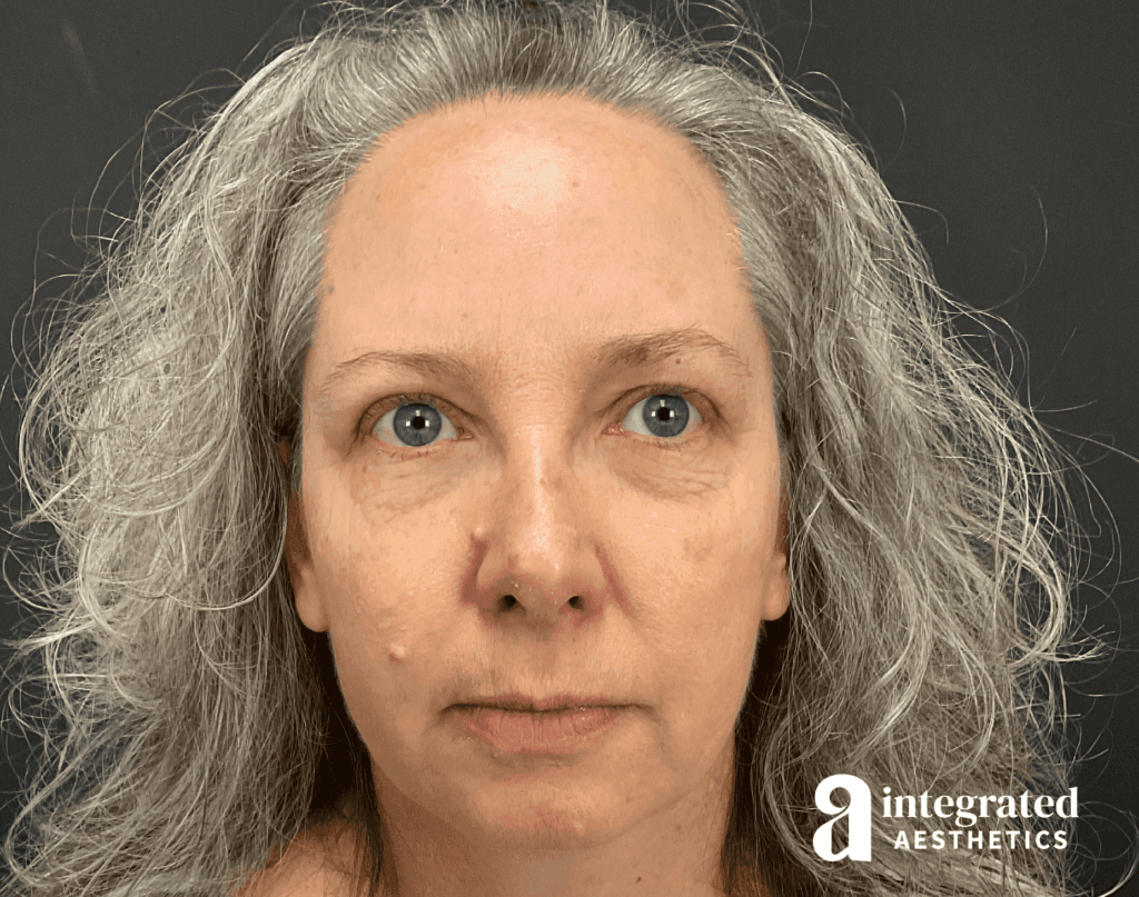 Wrinkle Relaxers