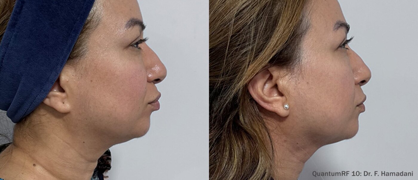 Quantum Facelift
