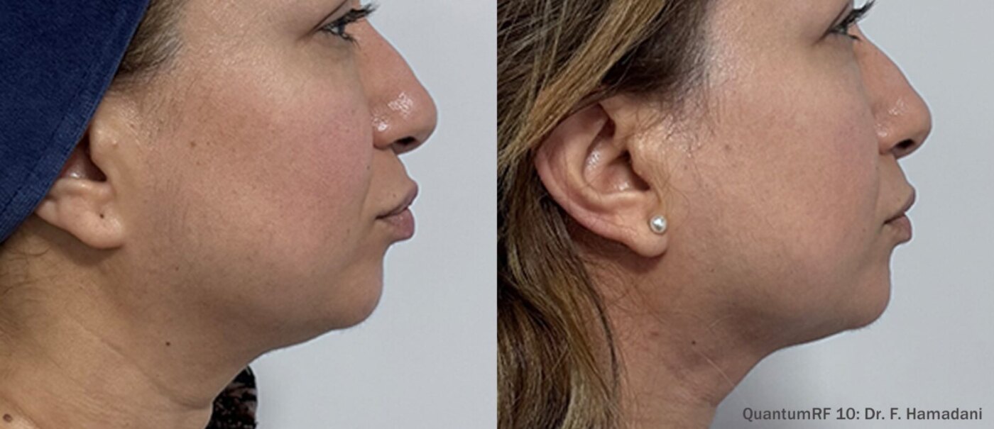 Quantum Facelift