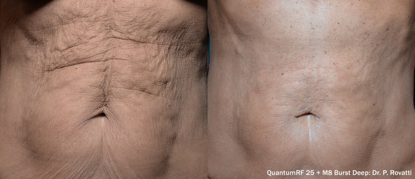 Quantum RF