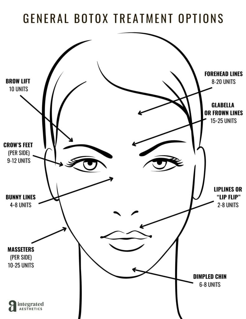 Illustration of general Botox treatment options for face