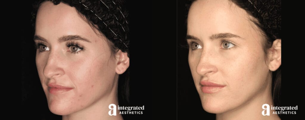 Sculptra before and after results
