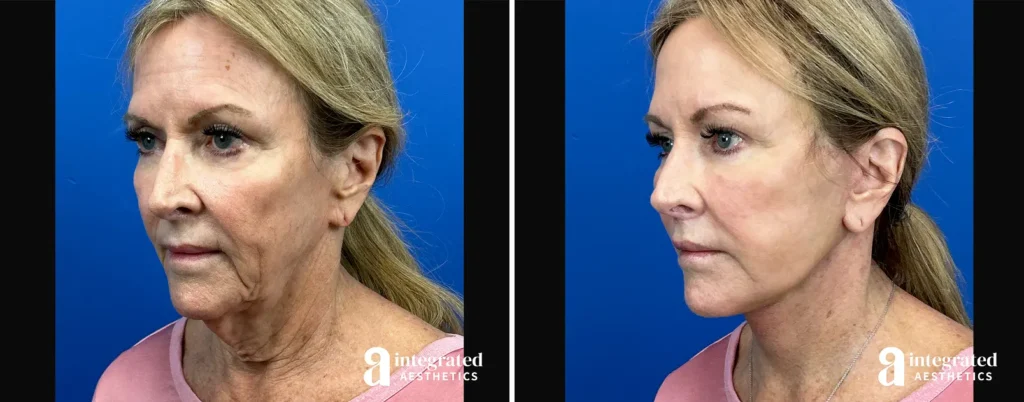 Endoscopic Brow Lift Before and After Patient Results