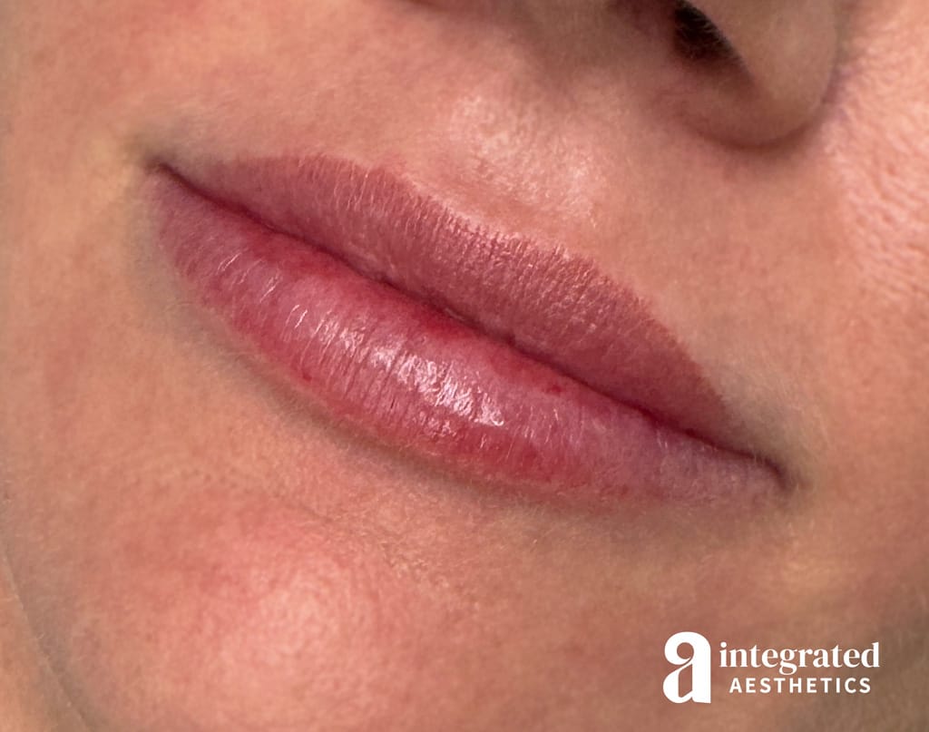 Lip Filler