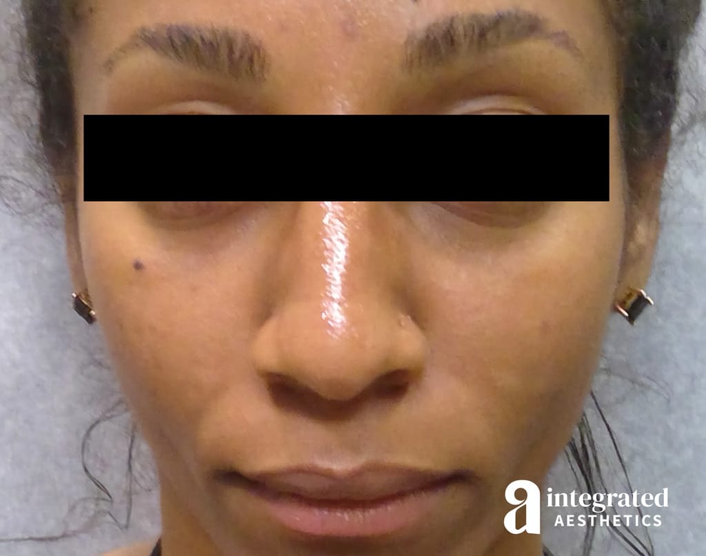 Dermal Fillers