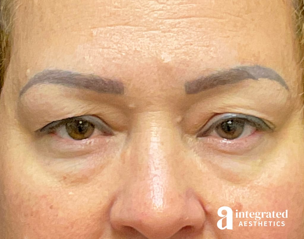 Blepharoplasty