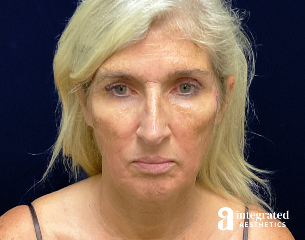 Lower Facelift & Neck Lift
