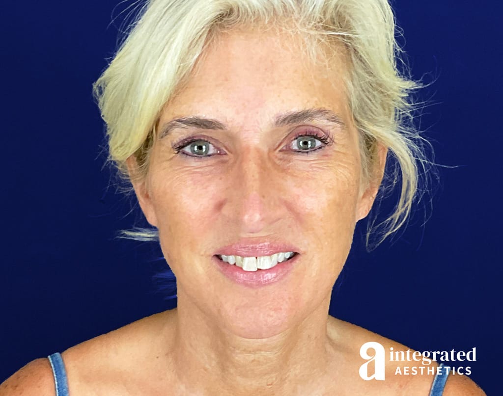 Lower Facelift & Neck Lift