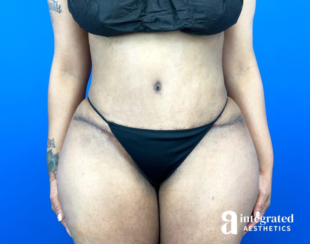 Tummy Tuck