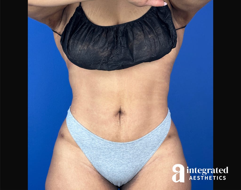 BodyTite with Liposuction