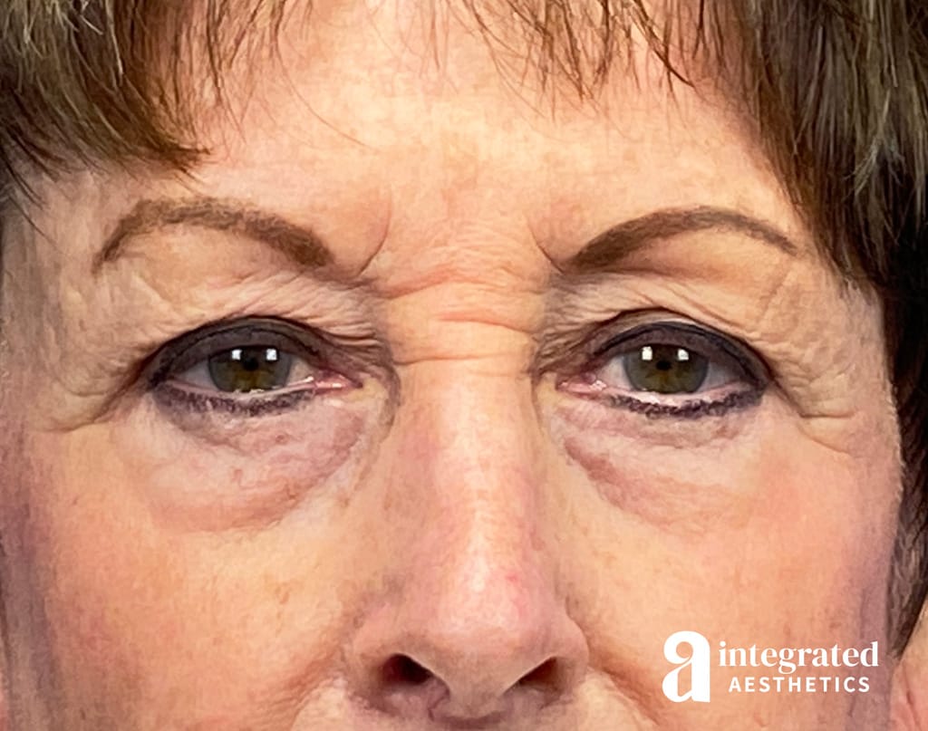 Blepharoplasty