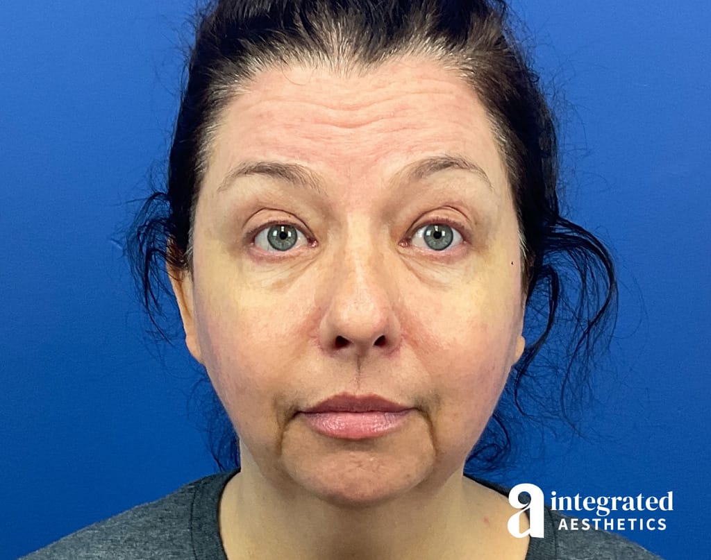 Wrinkle Relaxers