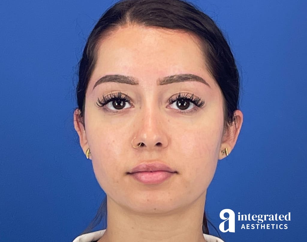Dermal Filler and Wrinkle Relaxer