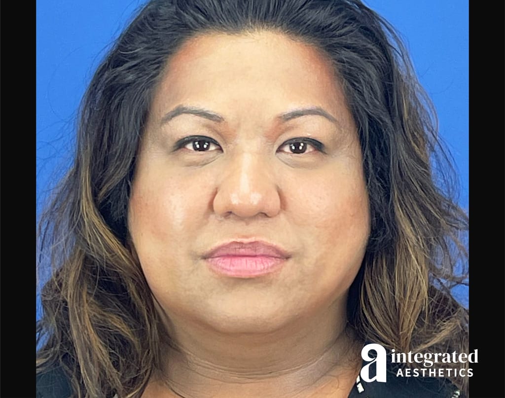 Facial Combined Procedures