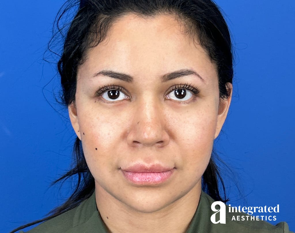 35-Year-Old Deep Plane Facelift and Blepharoplasty Before and After Results at 1 Month