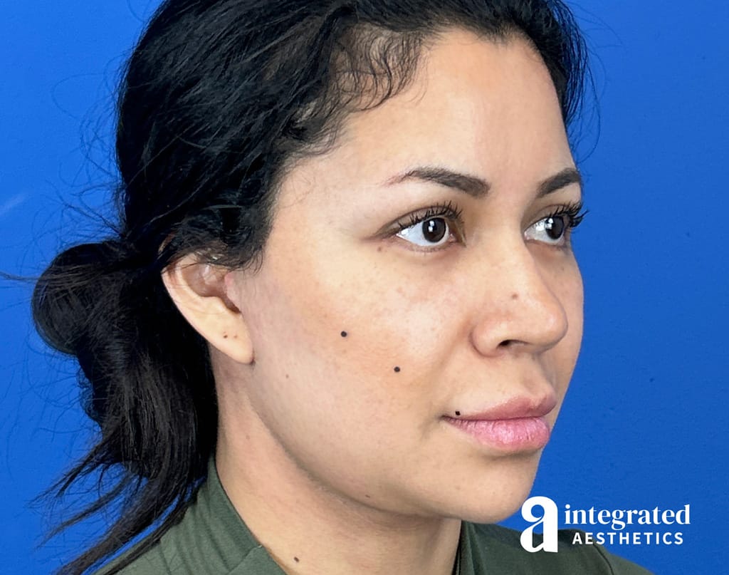 35-Year-Old Deep Plane Facelift Case Study The Woodlands TX