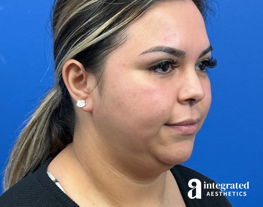 Submental Liposuction and Facetite
