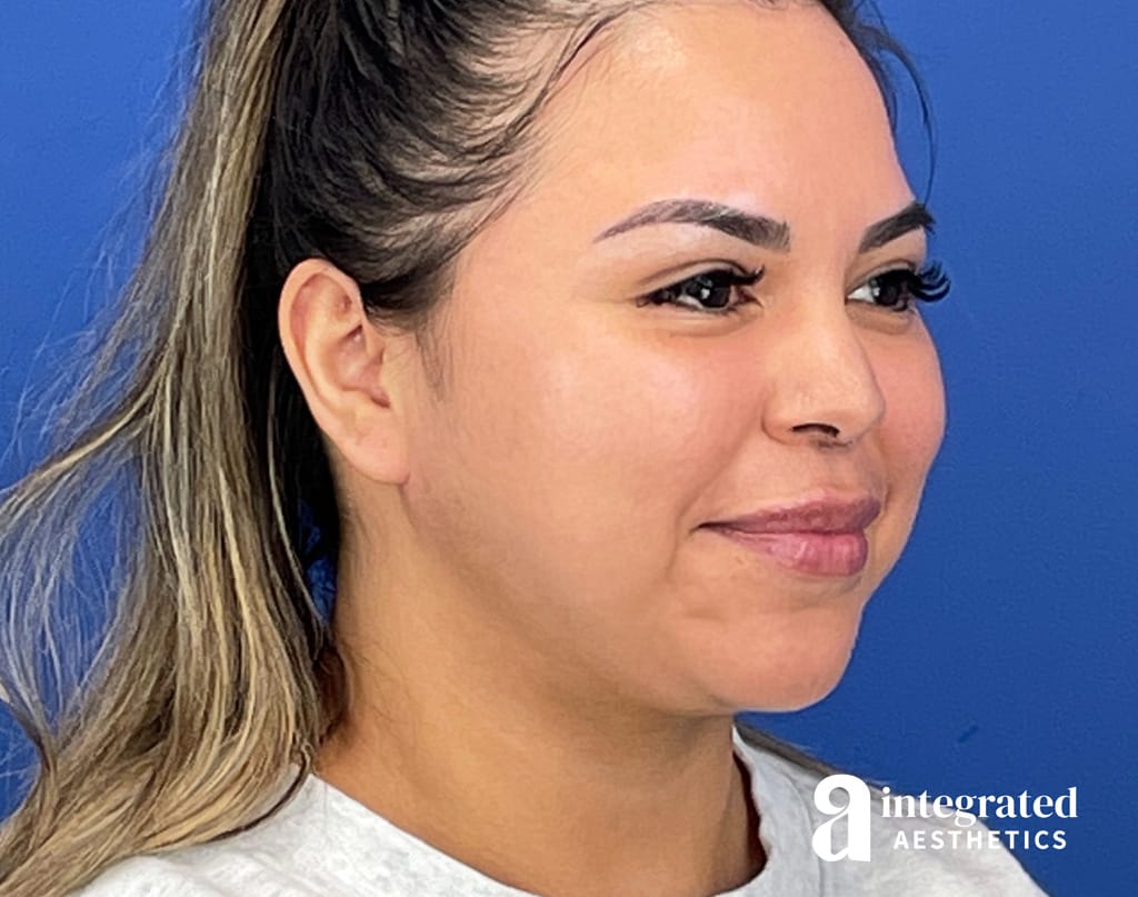 Submental Liposuction and Facetite