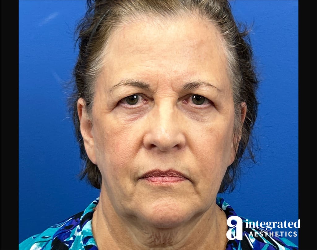 Quantum Facelift