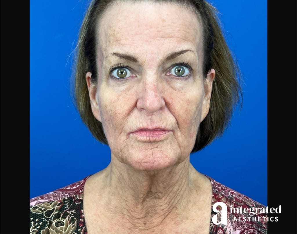 Facial Combined Procedures