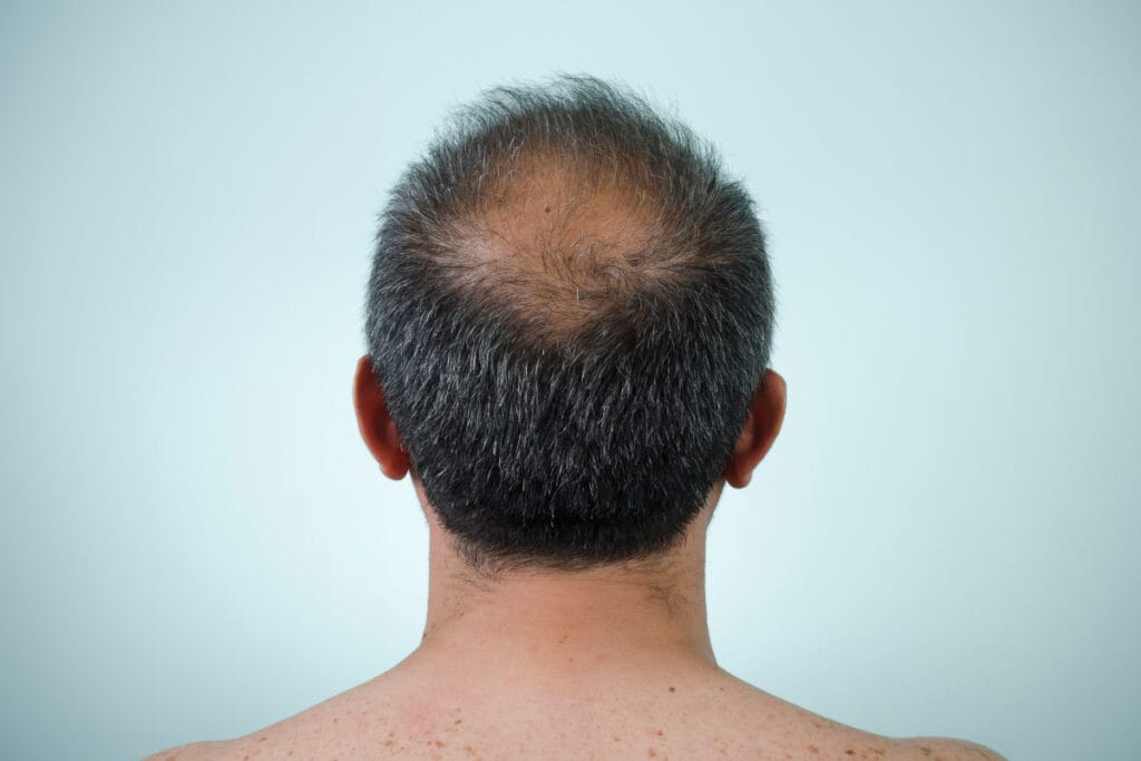 Back of man's head with thinning hair