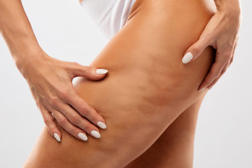 Close up of woman with cellulite on her legs