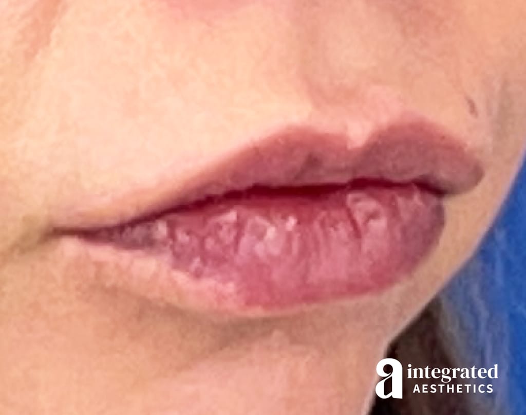 Lip Filler