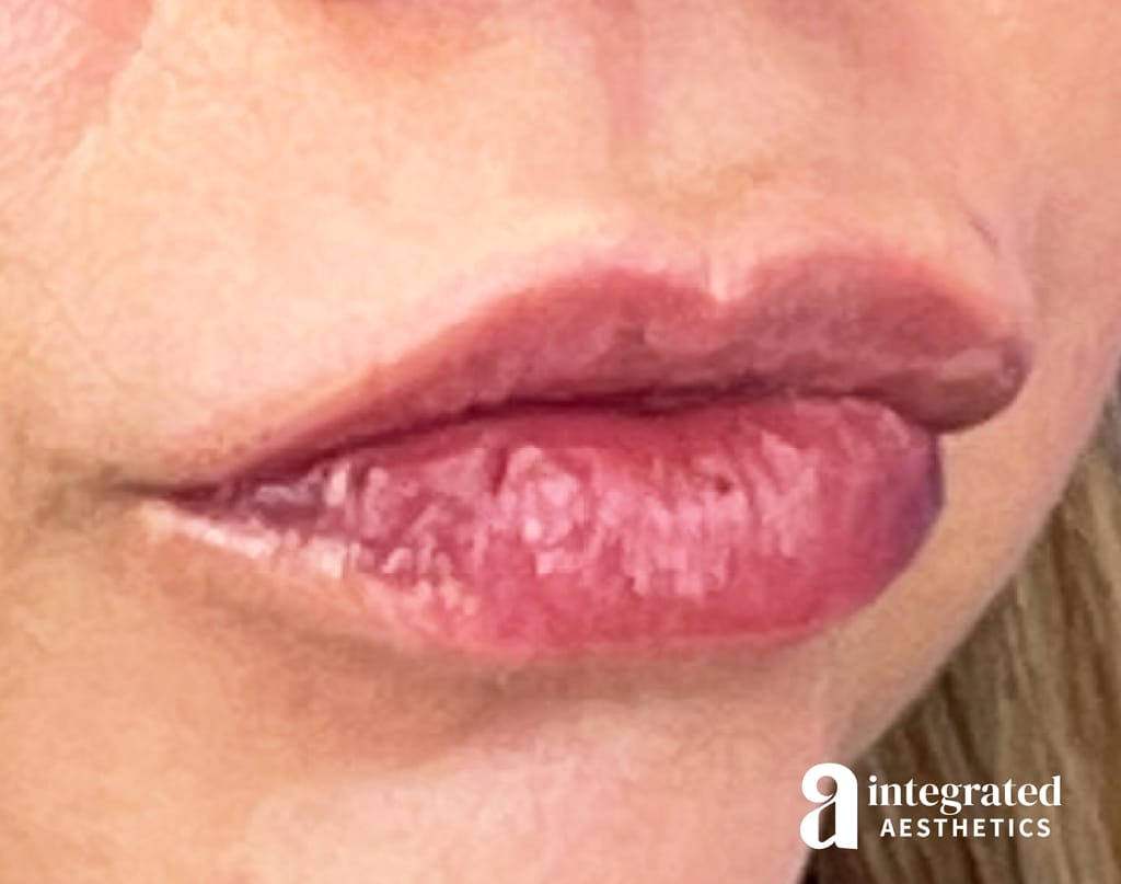 Lip Filler