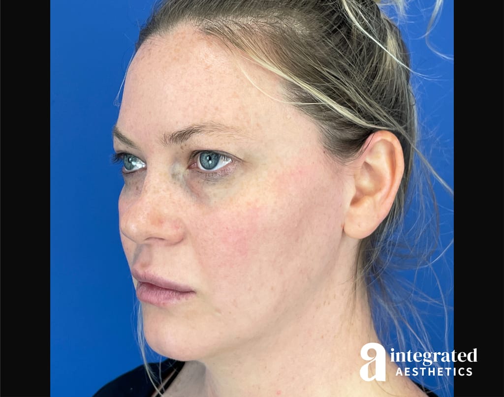 Quantum Facelift
