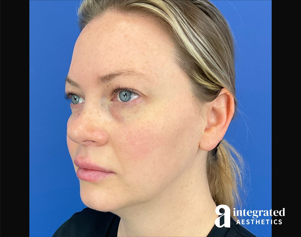 Quantum Facelift