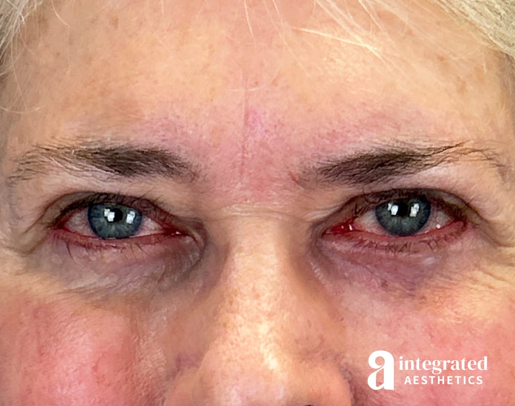 Blepharoplasty
