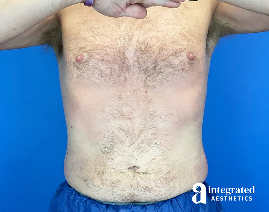 CoolSculpting