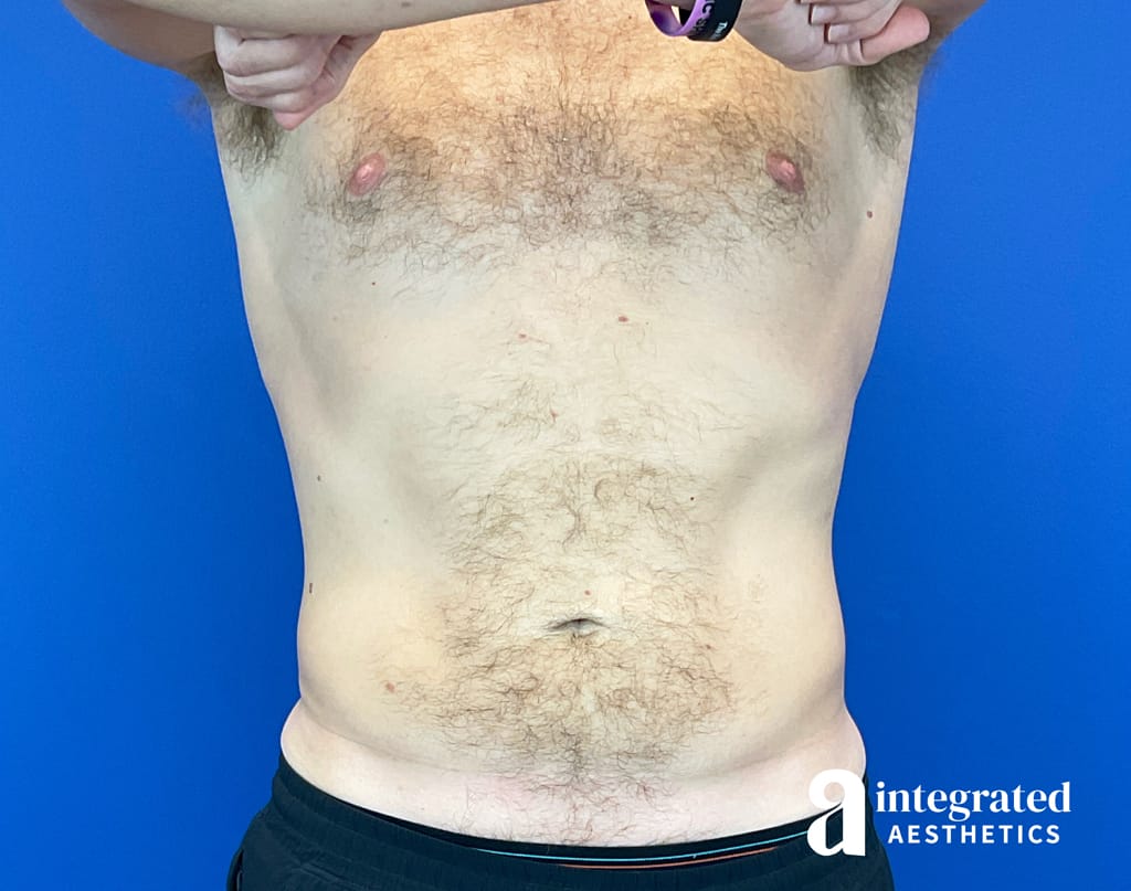 CoolSculpting