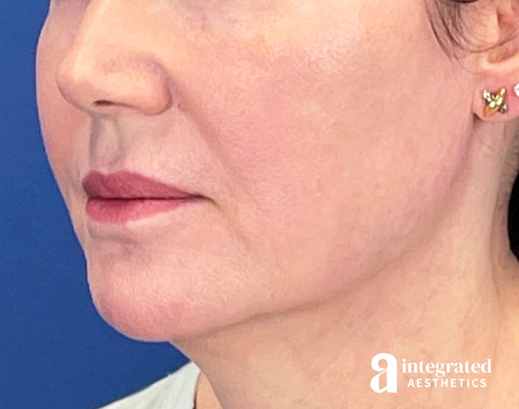 Dermal Filler Jawline