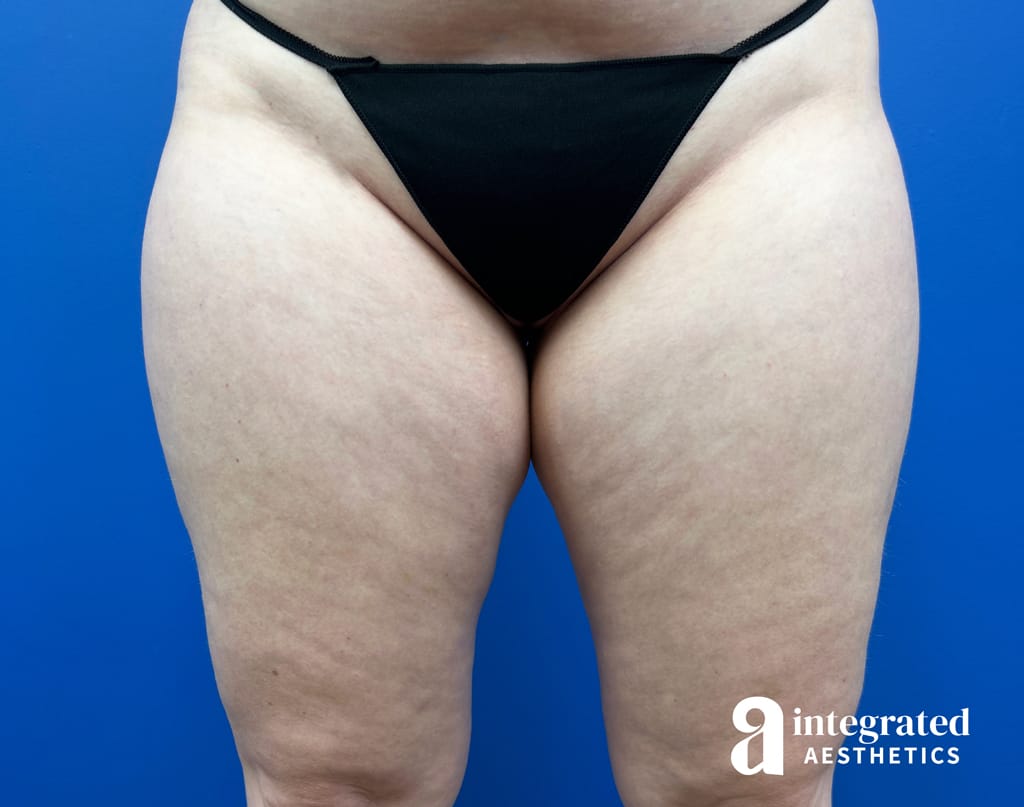 Bodytite & Liposuction