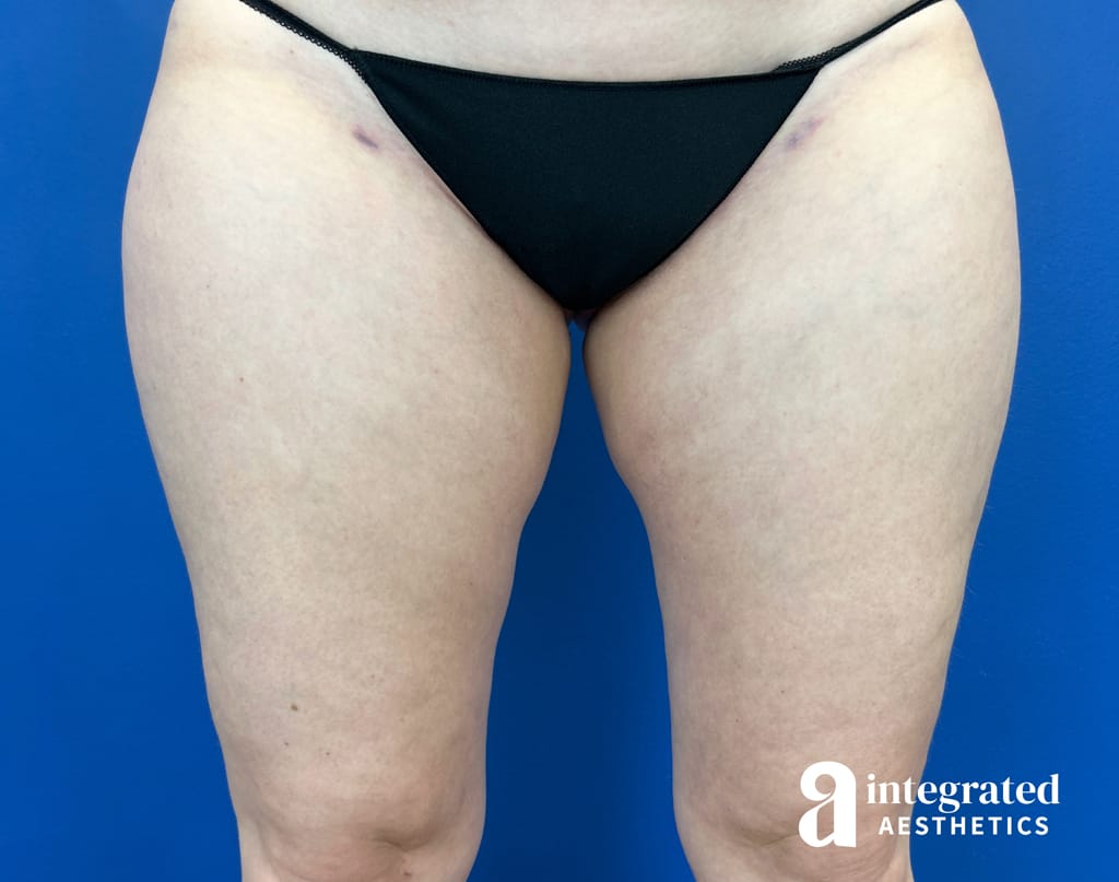 Bodytite & Liposuction