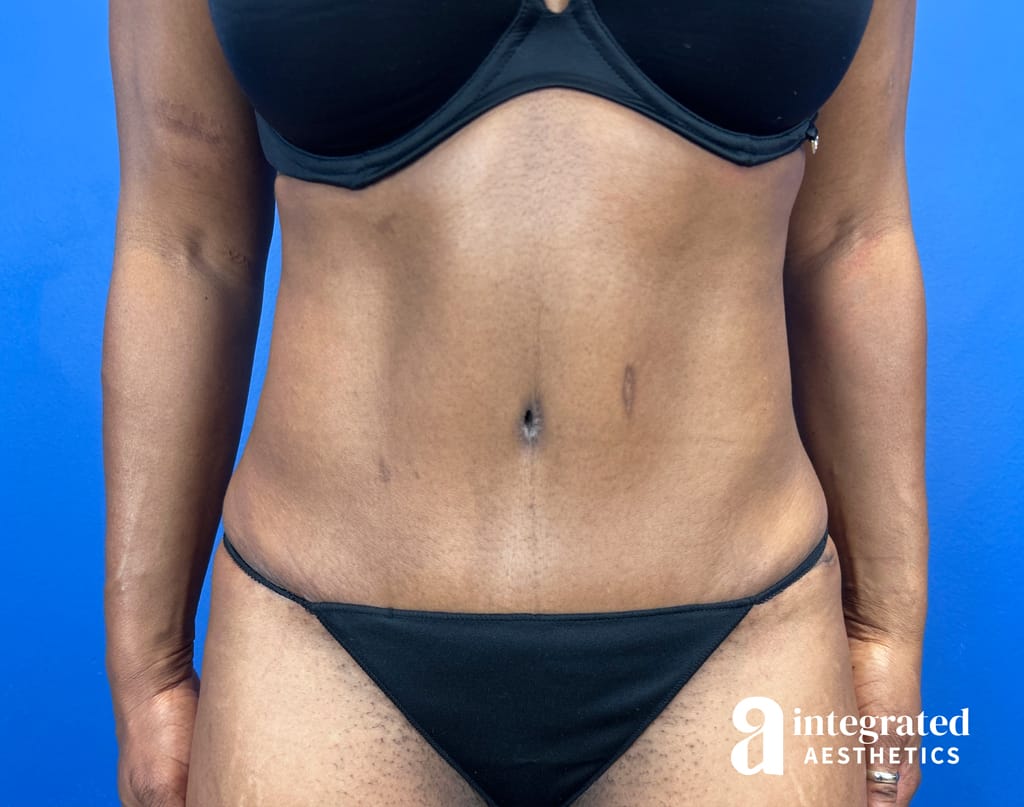 Tummy Tuck