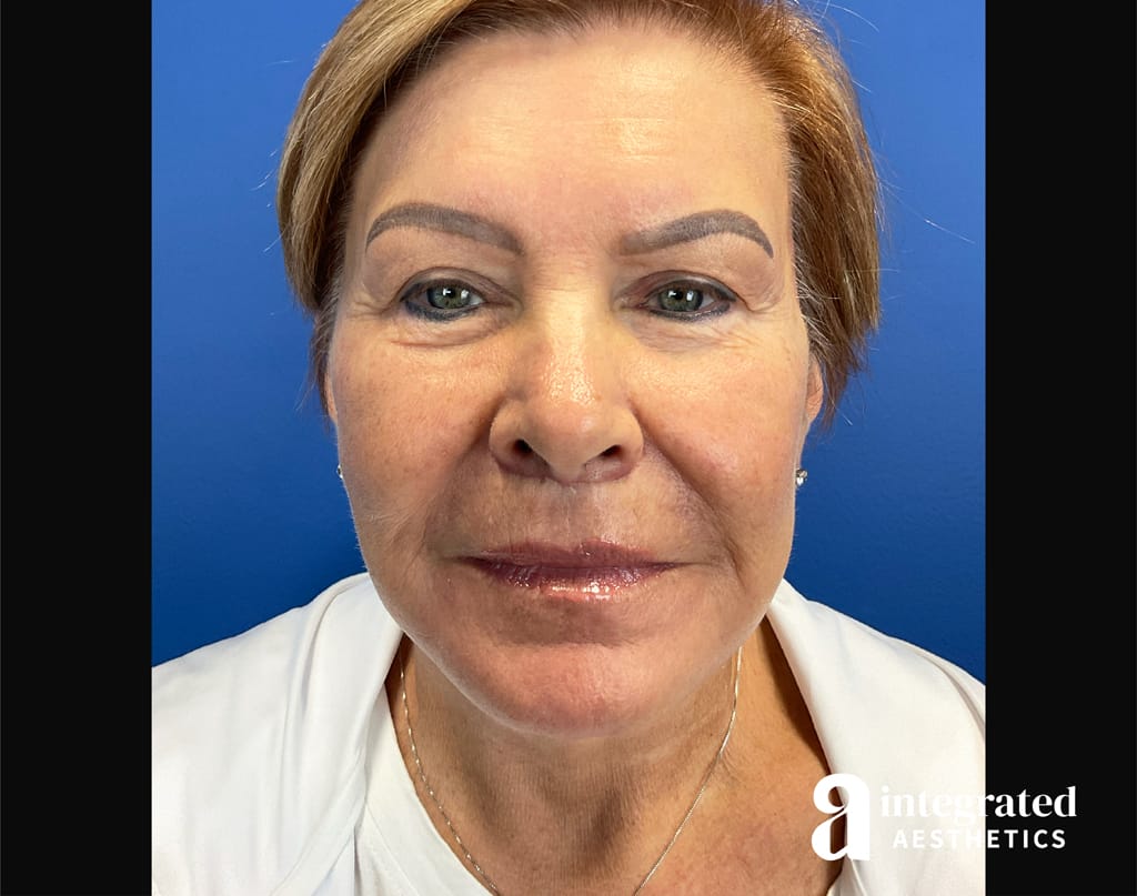 Facial Combined Procedures