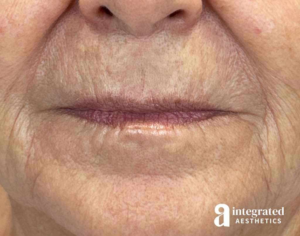 Lip Lift