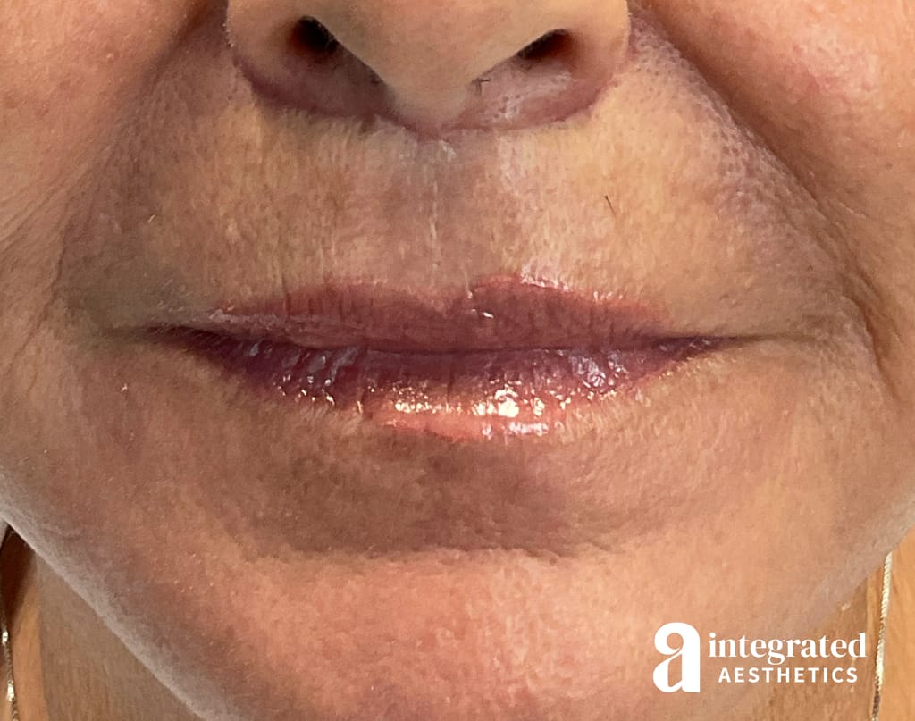 Lip Lift